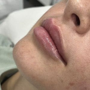 aumento de labios