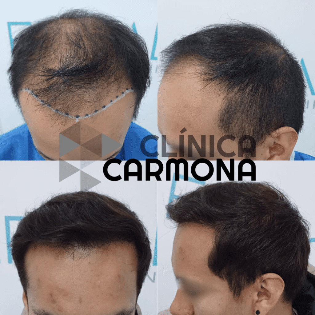 resultado injerto capilar