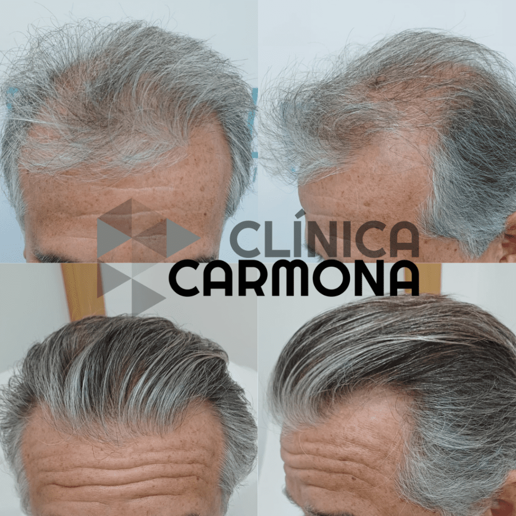 Injerto capilar totana