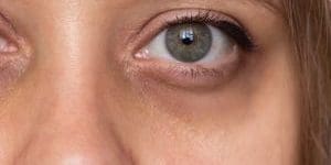 ojeras